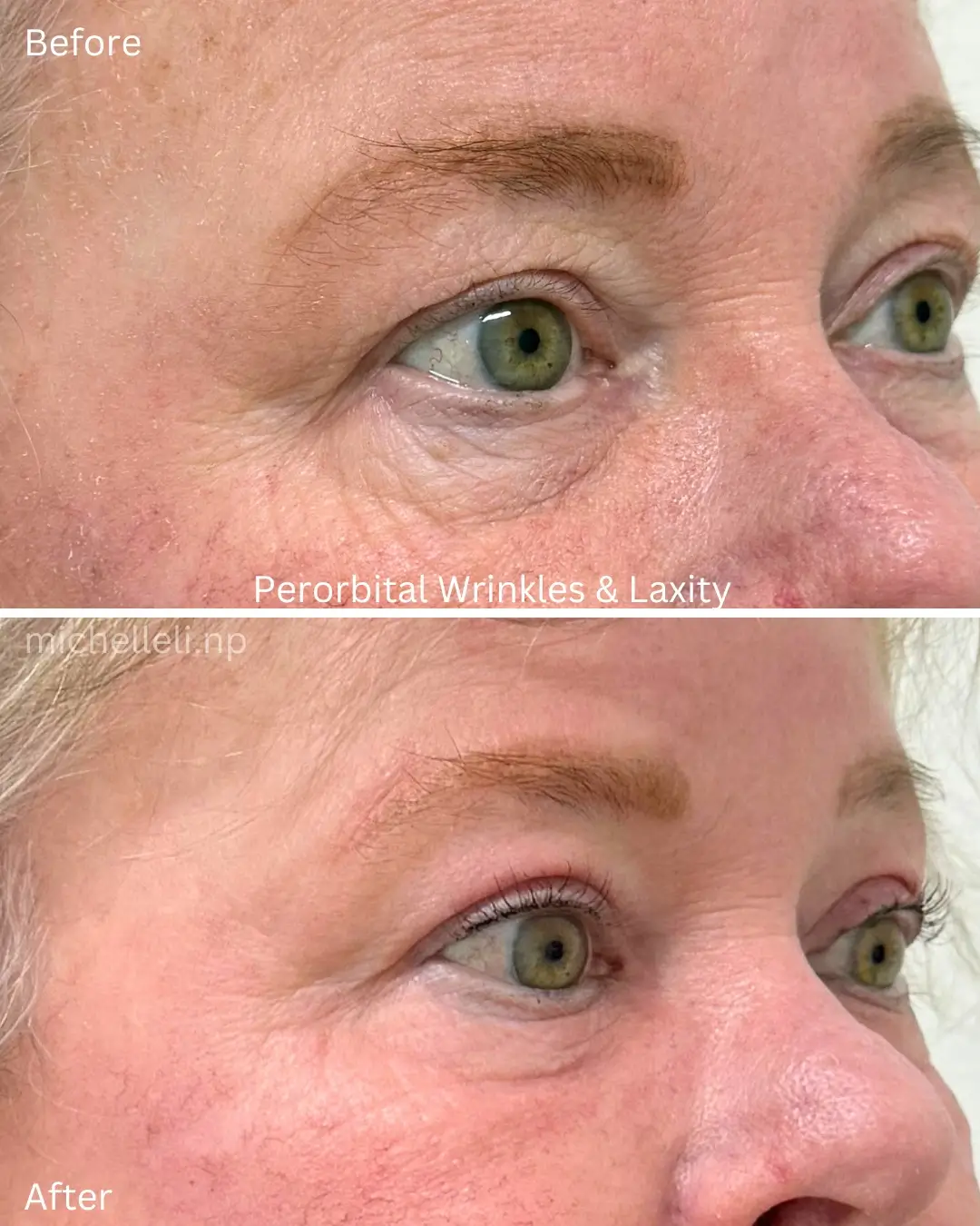 Before & after wrinkles & Laxity