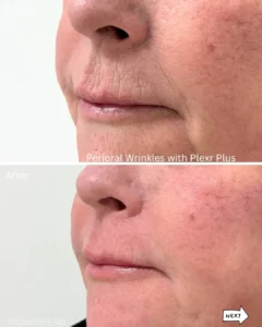Before & after Perioral wrinkles with Plexr plus