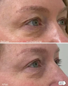 Before & after treatment