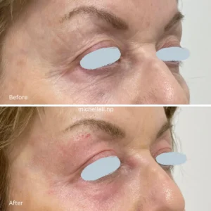 Before & after treatment