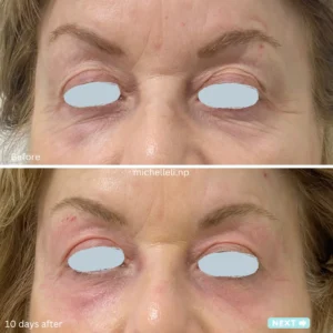 Before & after treatment
