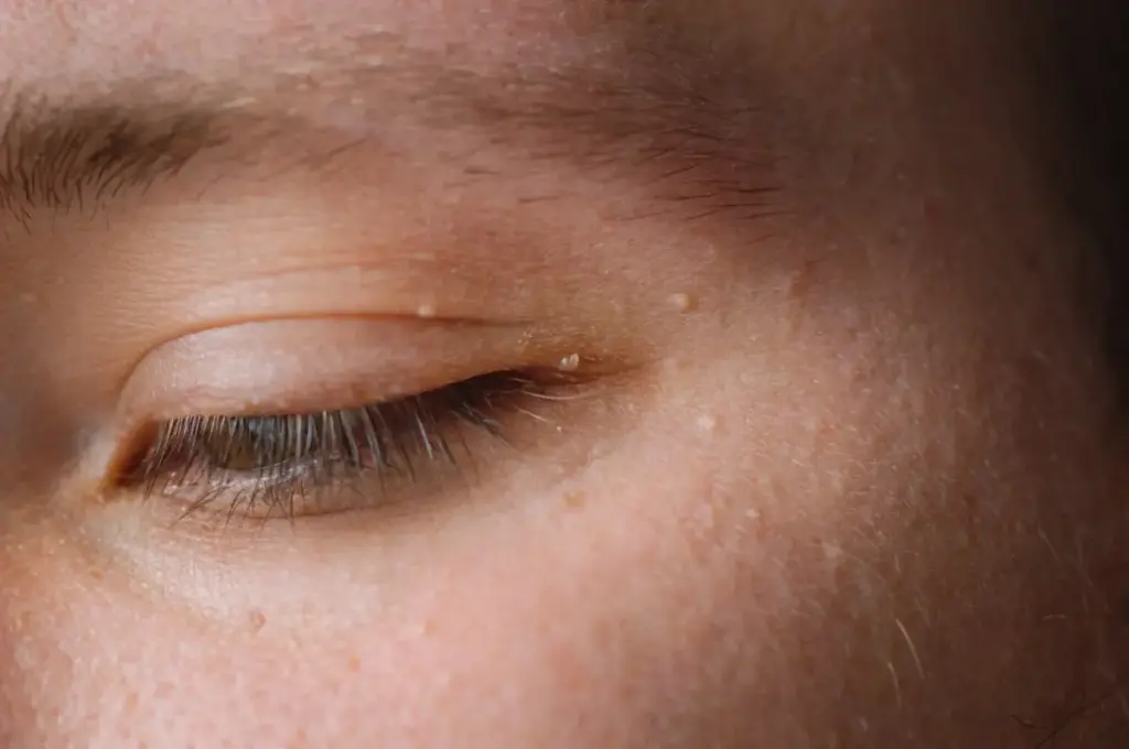 Benign Lesion Removal on Eyelids in London, ON