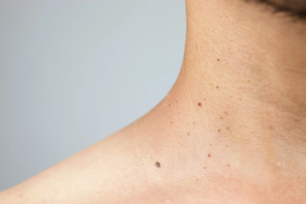 Benign Lesion Removal
