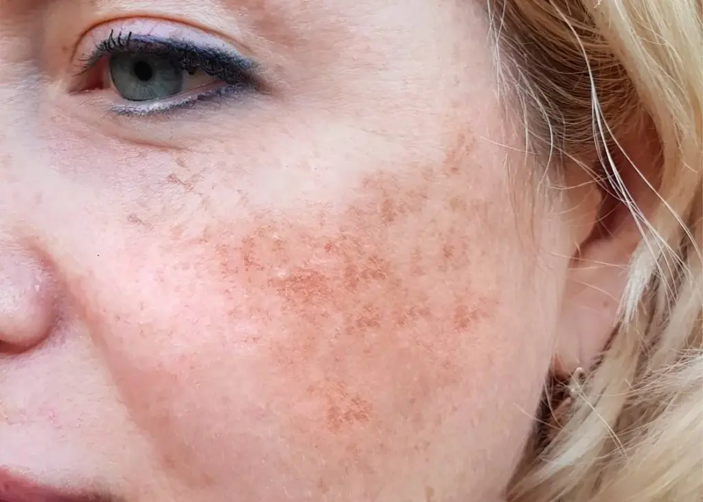 Melasma Treatment & Dark Spot Removal in London, ON