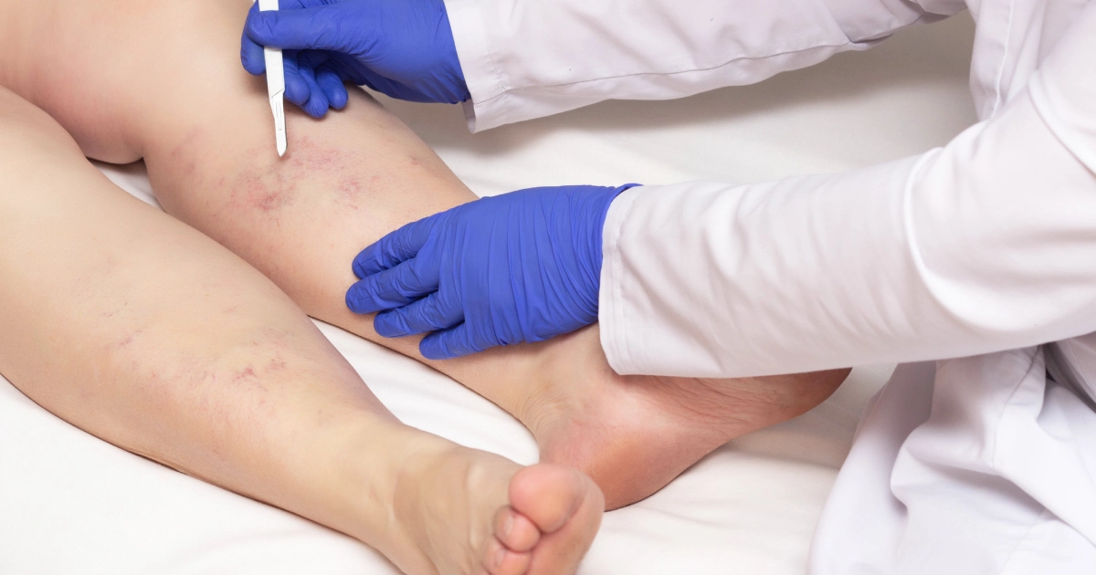 Doctor in blue gloves examining a patient's leg with Spider Veins in London, ON, using a small white medical instrument.