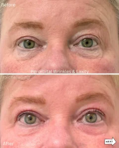 Before & after wrinkles & Laxity