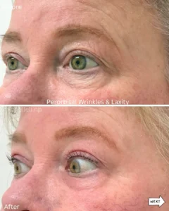 Before & after wrinkles & Laxity