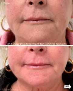 Before & after Perioral wrinkles with Plexr plus