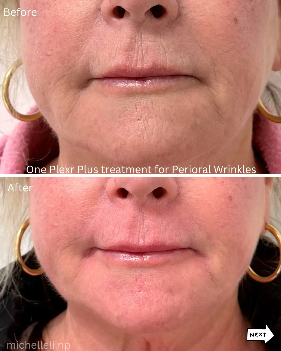 Before & after Perioral wrinkles with Plexr plus