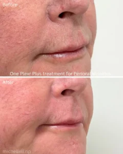 Before & after Perioral wrinkles with Plexr plus
