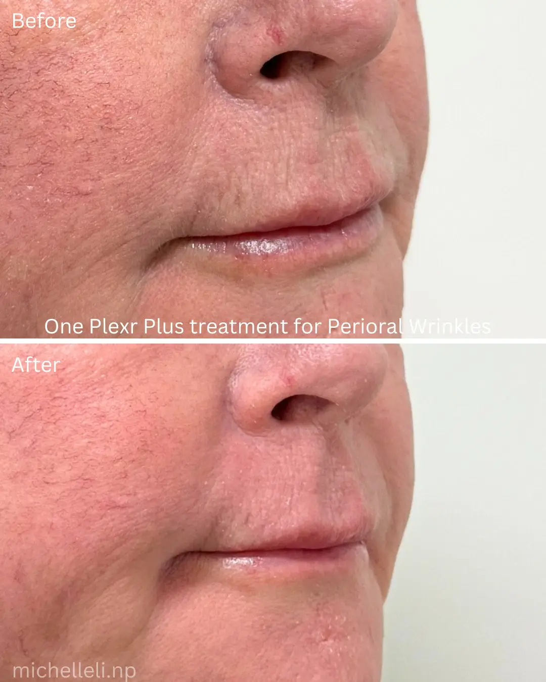 Before & after Perioral wrinkles with Plexr plus