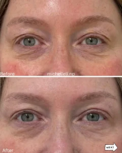 Before & after treatment