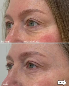 Before & after treatment