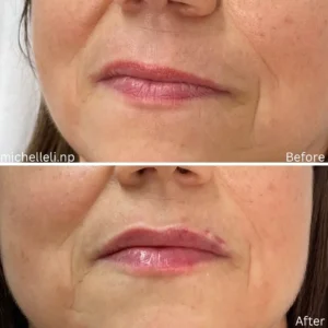 Before & after chin-filler treatment
