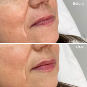 Before & after chin-filler treatment