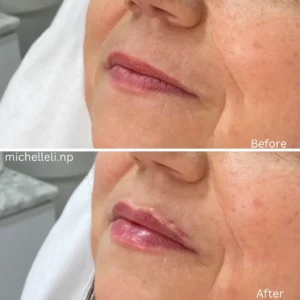 Before & after chin-filler treatment