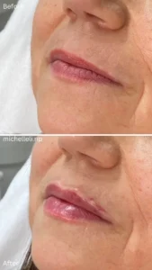 Before & after chin-filler treatment