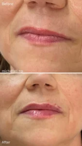 Before & after chin-filler treatment