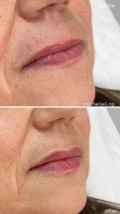 Before & after chin-filler treatment