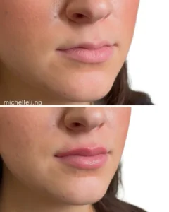 Before & after chin-filler treatment