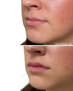 Before & after chin-filler treatment