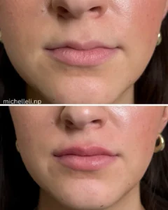 Before & after chin-filler treatment