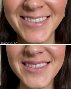 Before & after chin-filler treatment