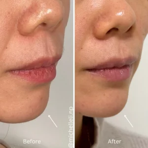 Before & after chin-filler treatment