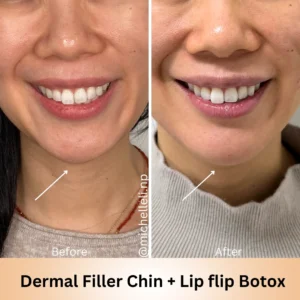 Before & after chin-filler treatment