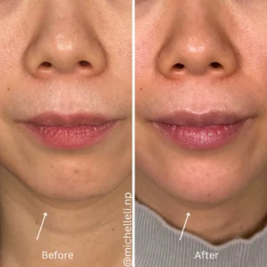 Before & after chin-filler treatment