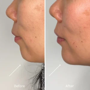 Before & after chin-filler treatment
