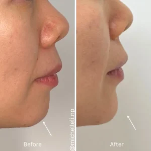 Before & after chin-filler treatment