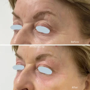 Before & after treatment