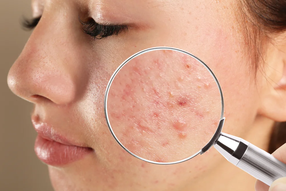 Acne Treatment & Scar Reduction in London, ON | Skincare