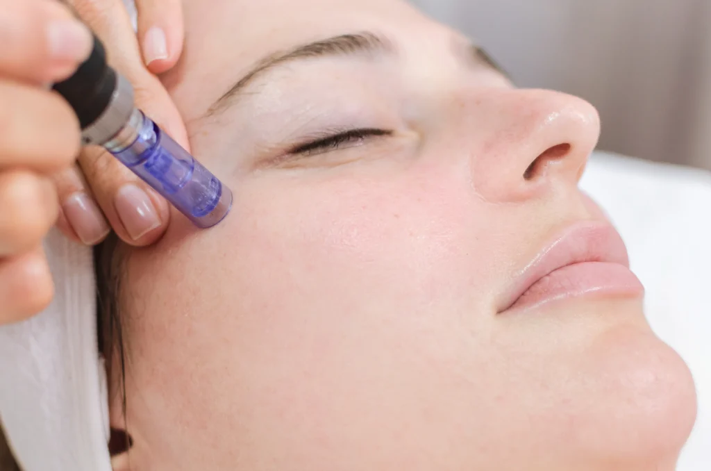 A woman taking Microneedling treatment in London, ON