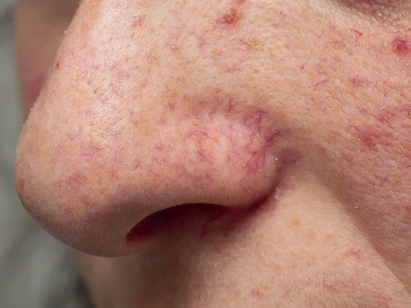 Rosacea Treatment & Redness Relief in London, ON