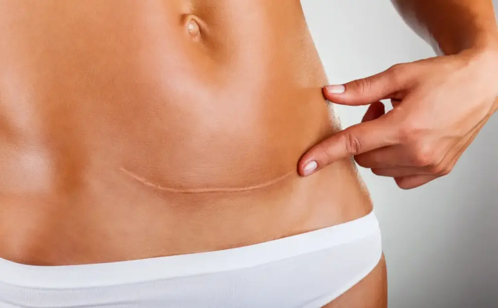 Scar Revision in London | Smooth, Even Skin Without Surgery