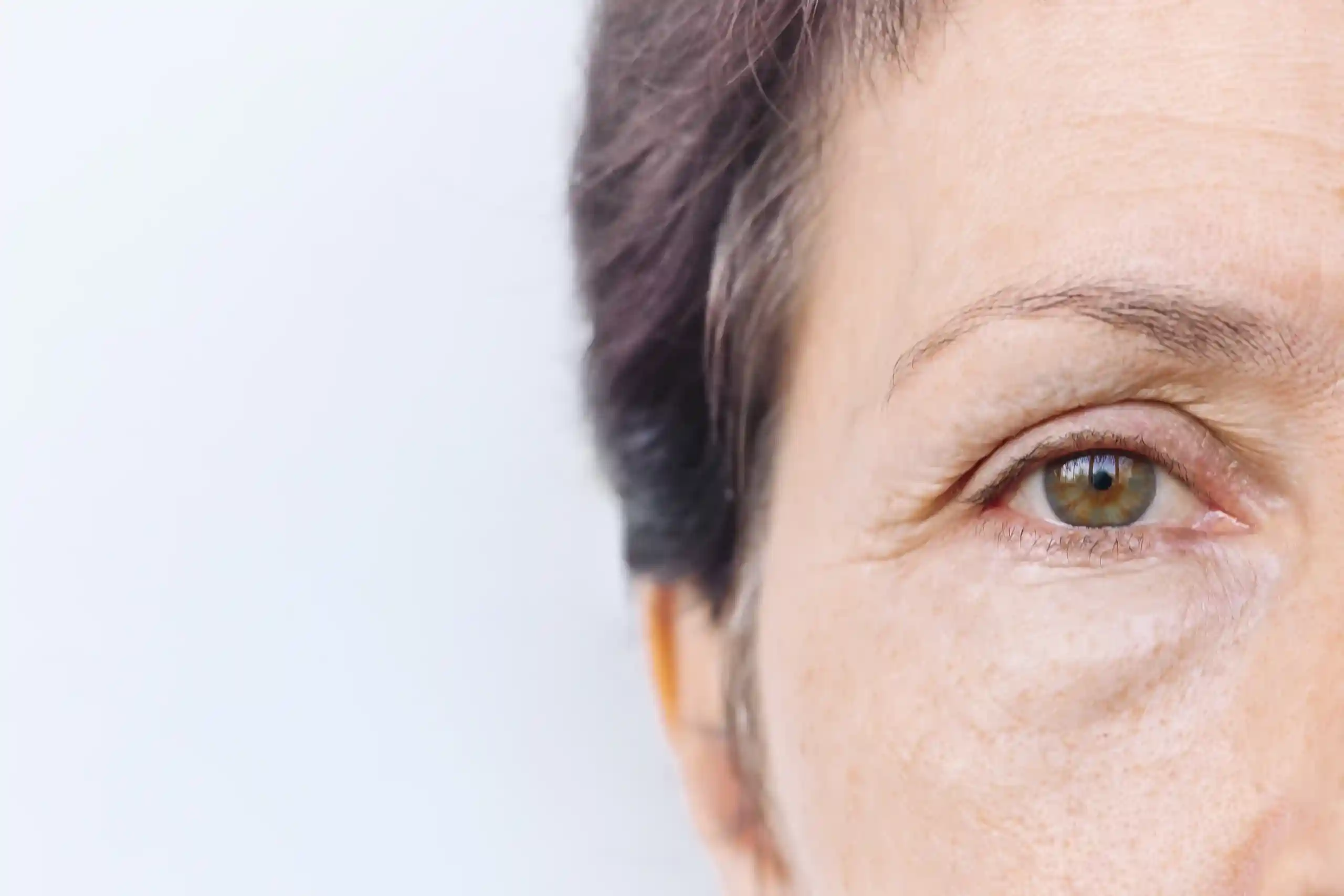 A woman with Eyebag & Festoon Treatment in London, ON
